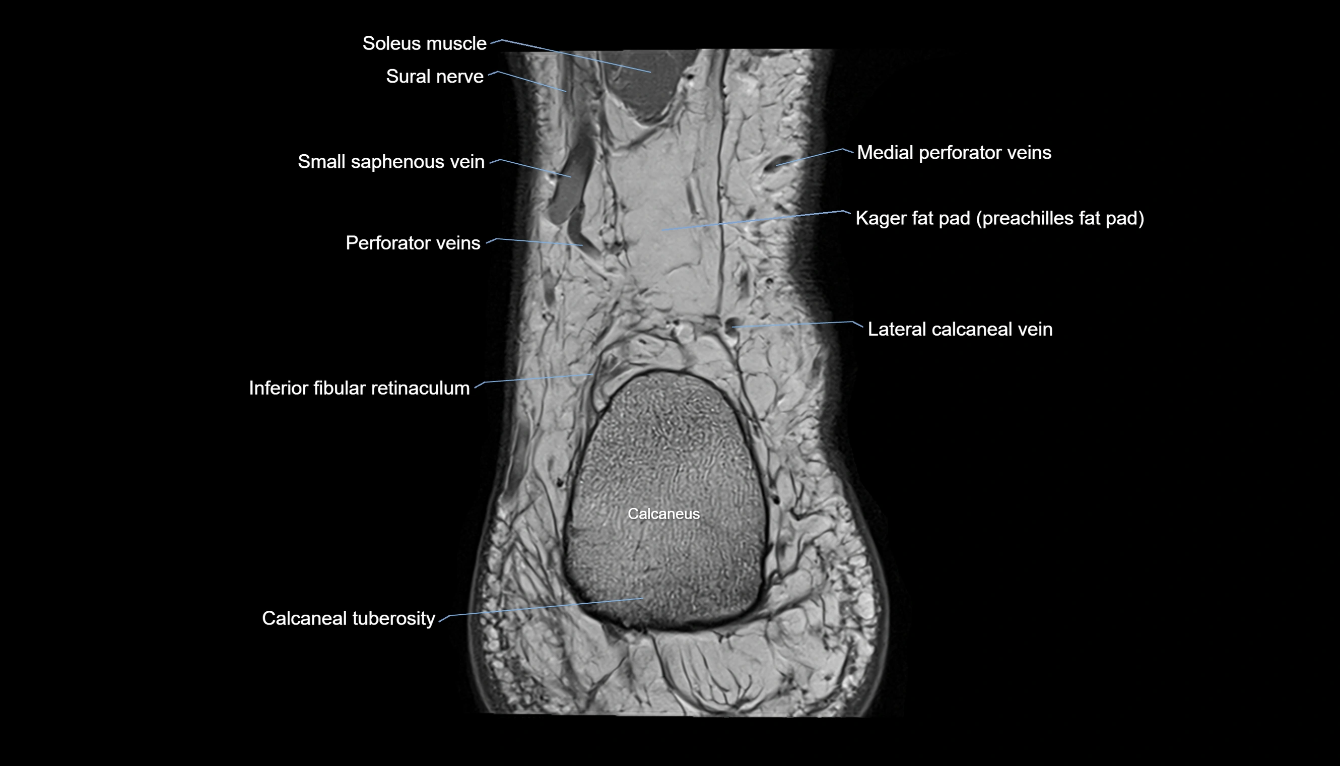 Ankle coronal anatomy 3T MRI images -img-11001-00028.webp